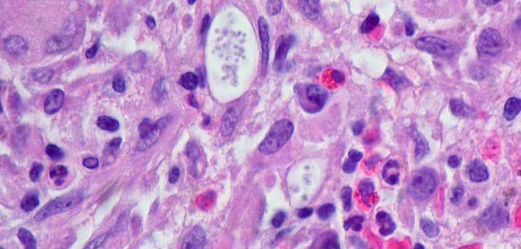 New HSS Study: Bone Fill in a Septic Condition Praised