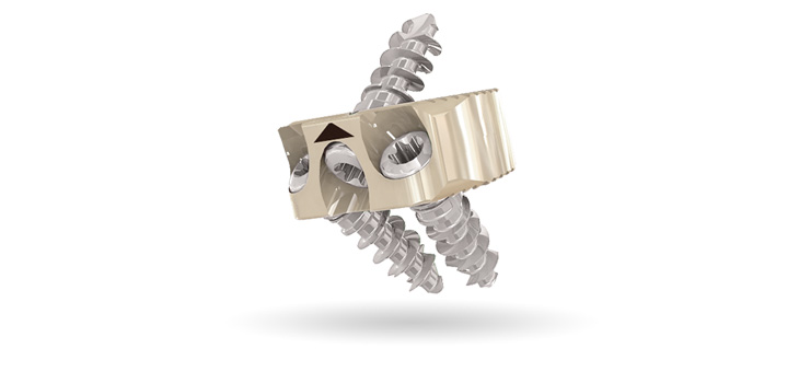 Centinel Spine Reaches 20, 000 Implantations of STALIF C