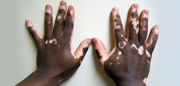 RA Medicine Cures Vitiligo?