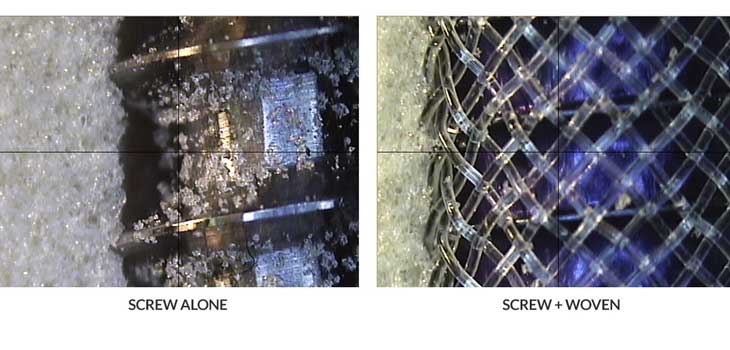 $6.6 Million for Woven Orthopedic Technologies
