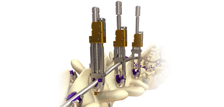 New K2M Deformity System Cuts Surgical Steps in Half