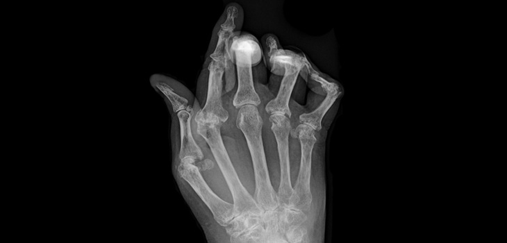 Predicting Which RA Patients Won’t Respond to Biologic Drugs