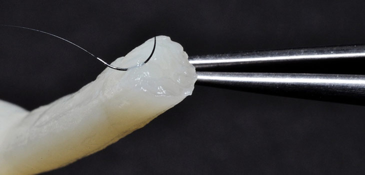 Ground Breaking Nerve Transplant Study Underway