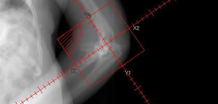 Revision Rate Reported For Elbow Arthroplasty
