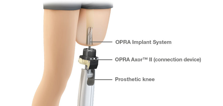New Leg Prosthesis Gains FDA Approval