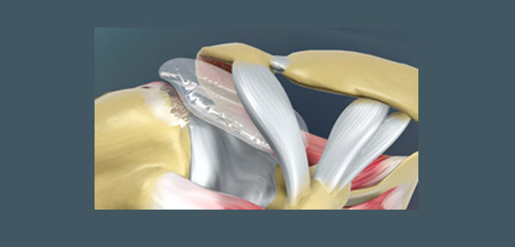 Trial Begins for Novel, Balloon MIS Rotator Cuff Repair System