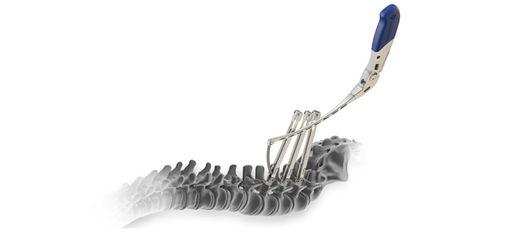 Medtronic Expands TLIF Procedure and Buys RF Surgical