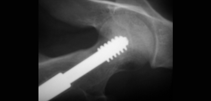Biodegradable Implant Metals – Next Big Thing?