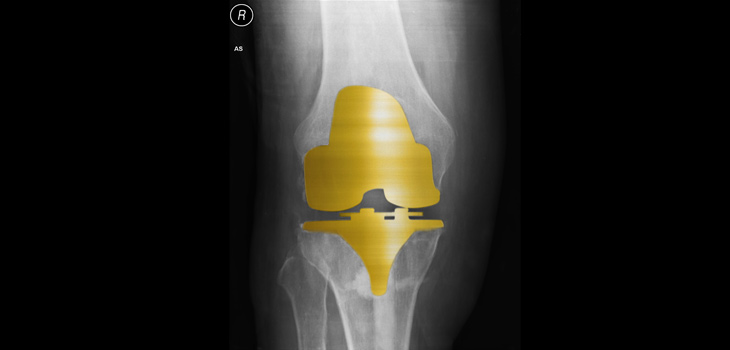 Gold Knee Implant, Literally