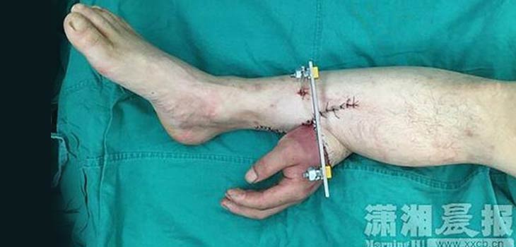 Chinese Surgeons Do it Again