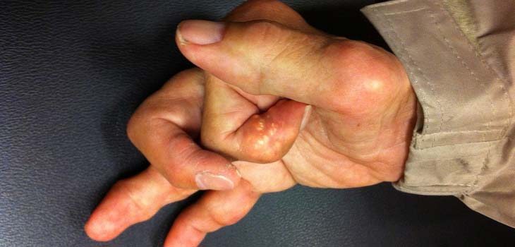 Arthritis Drug Could Treat Blood Cancer