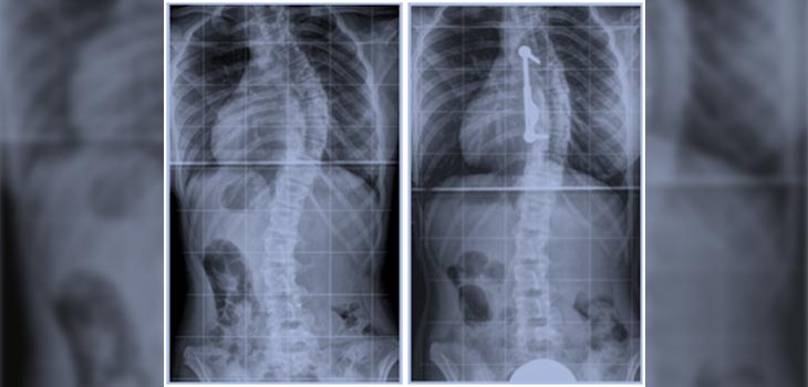 MIS Scoliosis Gets Boost from New Study