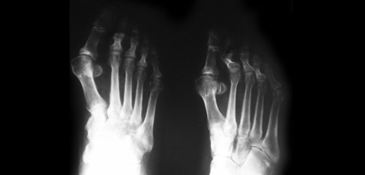 Type 2 Diabetes Risk Factor for Osteoarthritis