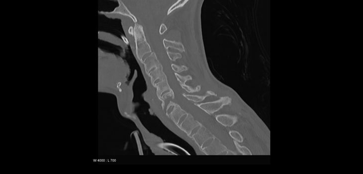 New Study: 60% More Stroke Risk for Ankylosing Spondylitis // Diabetics: 10x Less Bone Formation With Loading // and More!
