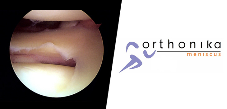 Orthonika: New Spinout From Imperial College London