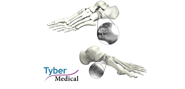 FDA Clears Tyber Medical’s Wedge System
