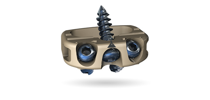 First Two Surgeries Performed Using Centinel Spine’s Midline II-Ti