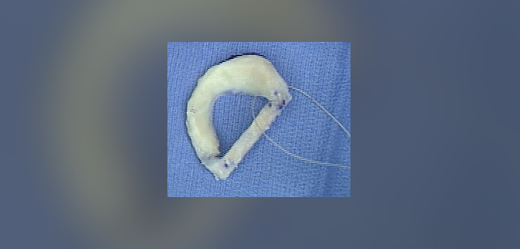 Transplant Successful for Most Young Patients With Damaged Menisci