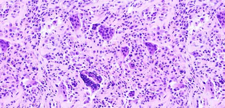 Study: CSF-1R Inhibitor Induced Tumor Regressions
