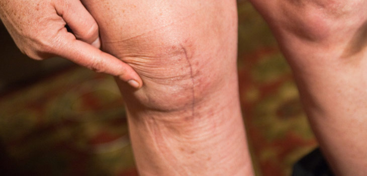 TKR in RA Patients: Highly Effective, But…