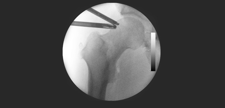 Largest-Ever Hip Arthroscopy Study Data May Surprise // HSS Scores #1 for 6th Year in a Row // and more!