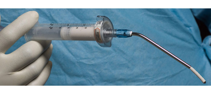 Subchondral Bone Marrow Lesion Cement Ok’d In Europe