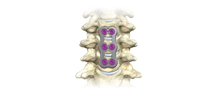 Xtant Medical Receives FDA Clearance for Cervical Plate