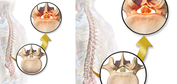 Study: Spinal Stenosis Patients DO Respond Well to Epidural Steroids