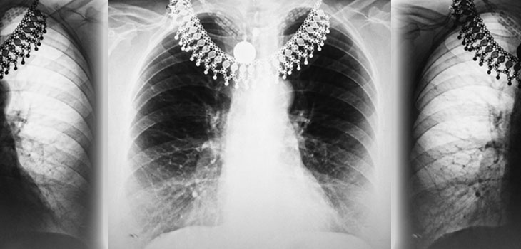 Study Counts Retained Surgical Items in Patients