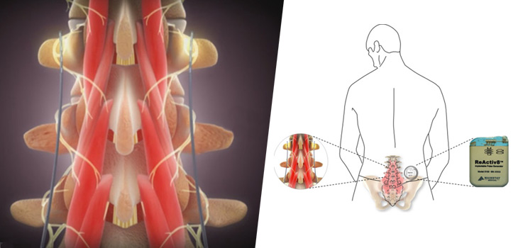 Device Attacks Chronic Lower Back Pain