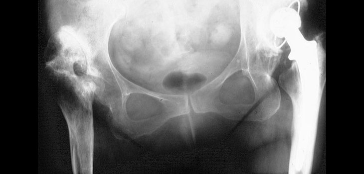 Psoriatic Arthritis No Bar to Joint Replacement