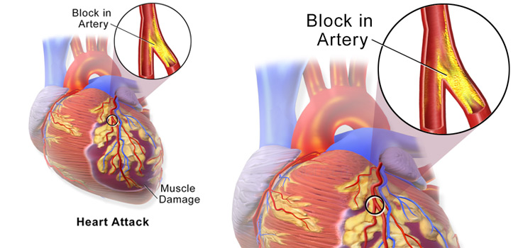 Heart Attack Risk Soars After Joint Replacements