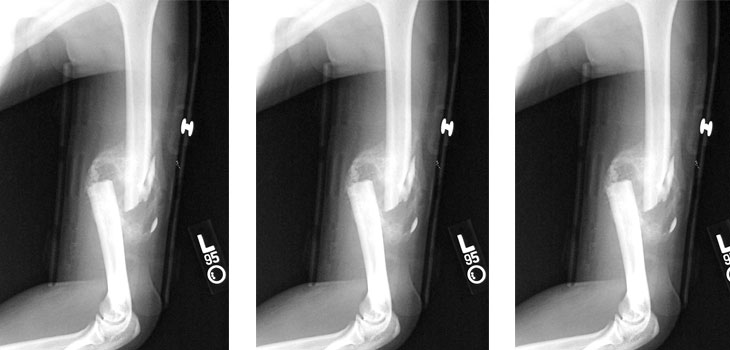 Found! Gene Responsible for BMD and Fracture Risk!