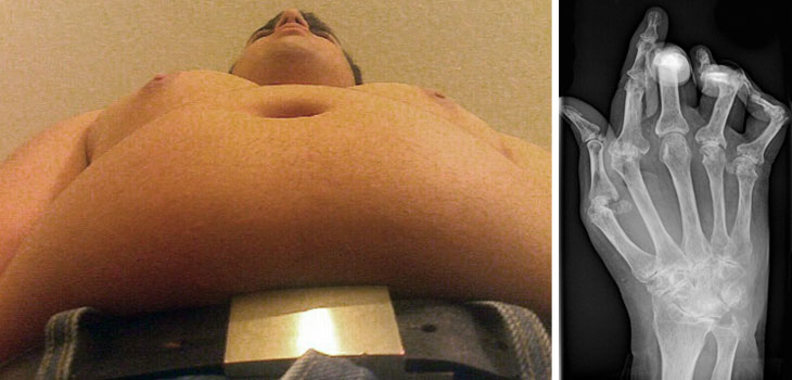 High BMI Reduces Risk of RA…in Men
