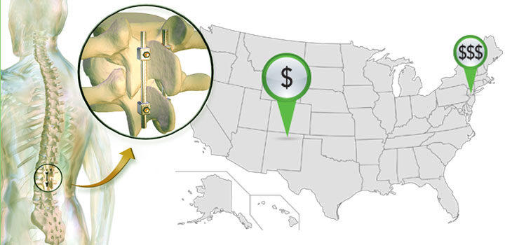 Huge Geographic Variations in Cost of Spinal Fusion