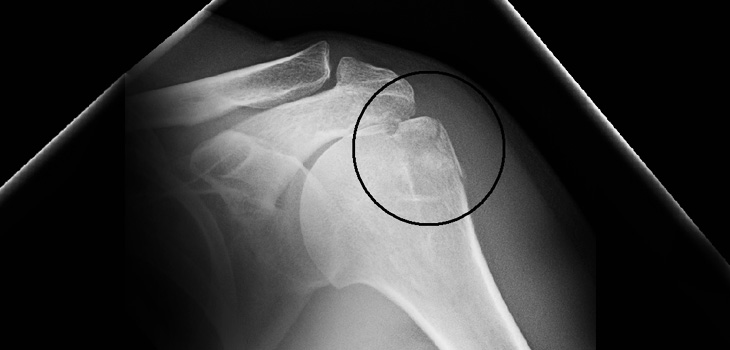 First In-Human Cases: PH Cage for Proximal Humeral Fractures