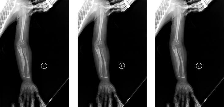 Bold Trial Targets Osteogenesis Imperfecta in Fetuses