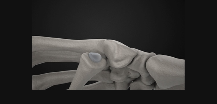 Cartiva Implants First Thumb Study Patient