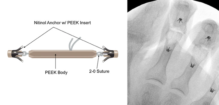 Cartiva Launches Toe Deformity Study