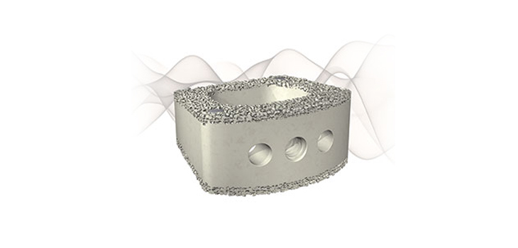 Uniquely Osteoconductive and Porous PEEK Device Gets FDA Nod