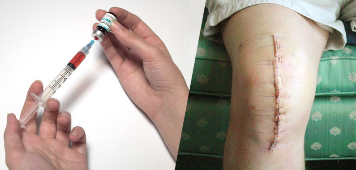 Continuous Bupivacaine Drastically Reduces Opioid Consumption
