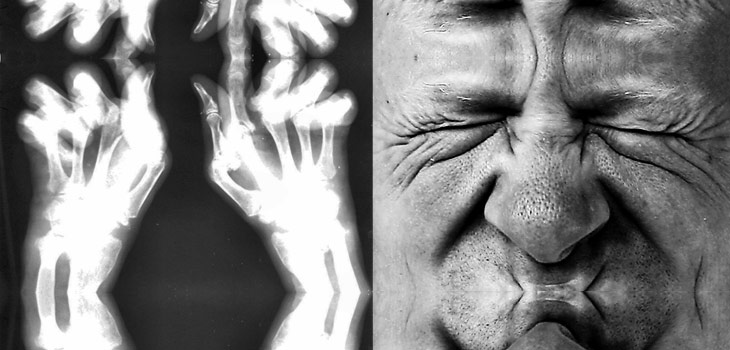 Eureka! New Information on Aggressive RA