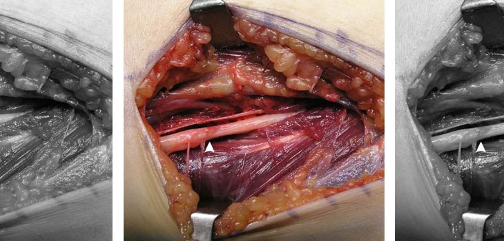 Nerve Transfer Surgery Treats Paralysis