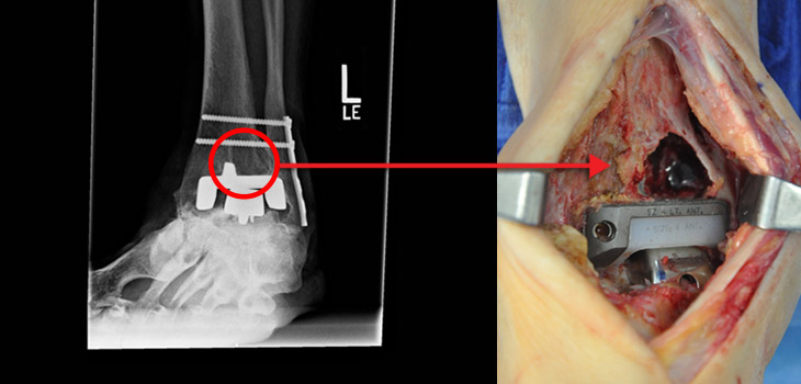 Osteolysis in Total Ankle Arthroplasty: Why So Many Early Failures? // Stunning New Implant Data From Registry Consortium // and More!