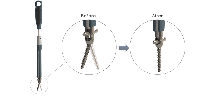 Safe Orthopaedics: FDA Approves Marketing of New Implant