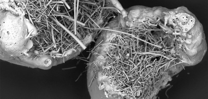 Bioactive Glass Cleared for Postero-Lateral Fusion