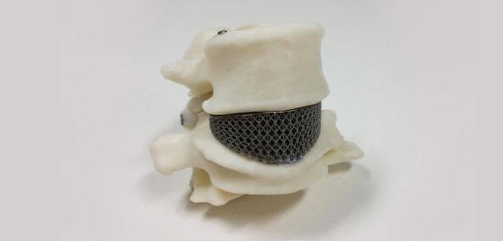 Doc Implants First 3D Spinal Cage in Australia