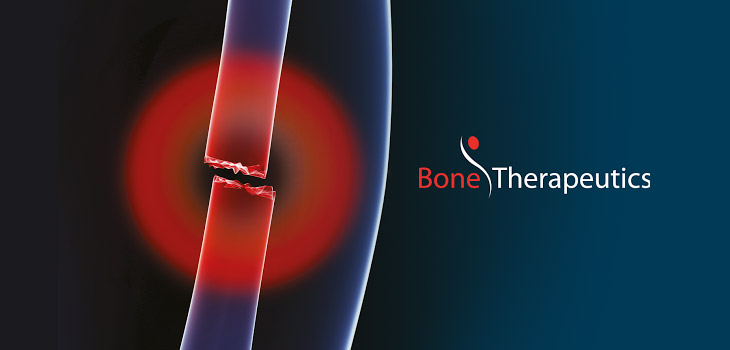 ALLOB Trial Adds Multiple Bone Fractures