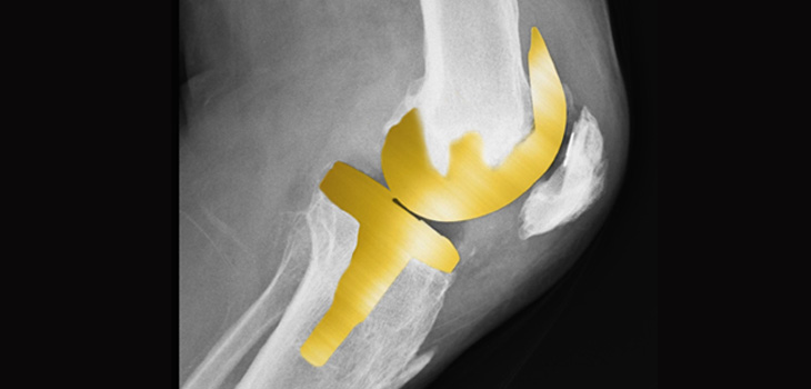 Gold Knee Implanted in India Patient