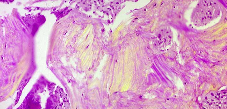 Found! How Gene Contributes to Paget’s Disease